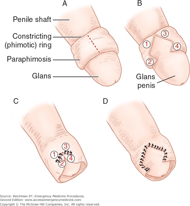 Alternative solution for phimosis that leaves the prepuce